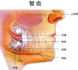  智齿拔除的必要性及术后注意事项探讨